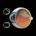 icone-descolamento-retina-v1